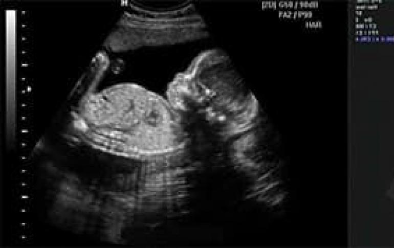 Ο πέμπτος μήνας της εγκυμοσύνης, η ανάπτυξη του εμβρύου και οι μητρικές αισθήσεις Το μέγεθος της κοιλιάς μιας εγκύου στους 5 μήνες.